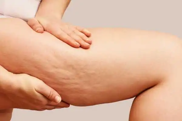 Image of woman showing leg with cellulite Netherton