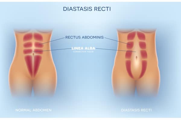 What Non-Surgical Options Are Available for Diastasis Recti Netherton?