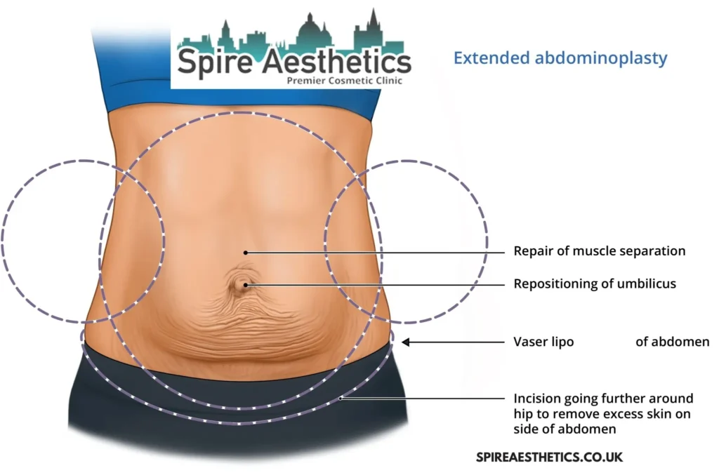 Understanding Loose Skin After Gastric Band Netherton Surgery and HIFU Treatment