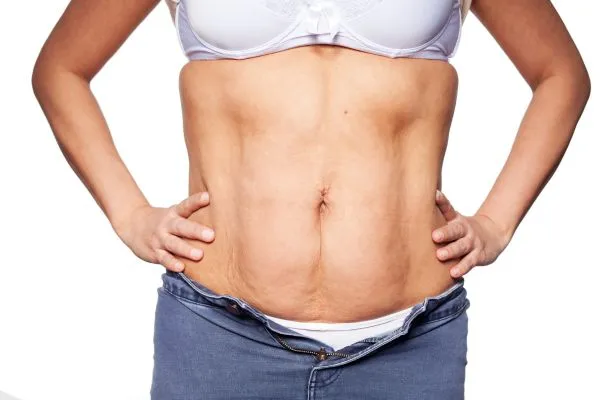 sagging skin on woman's stomach after weight loss injections Netherton