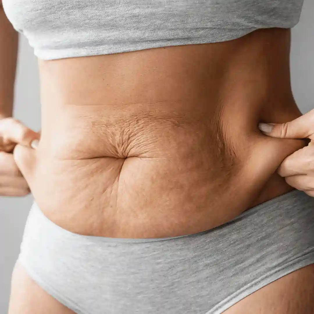 Is It Normal to Have Loose Skin After Pregnancy Netherton?